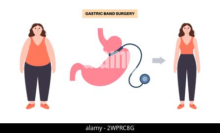 Magenbandärztliches Vorgehen, Illustration Stockfoto