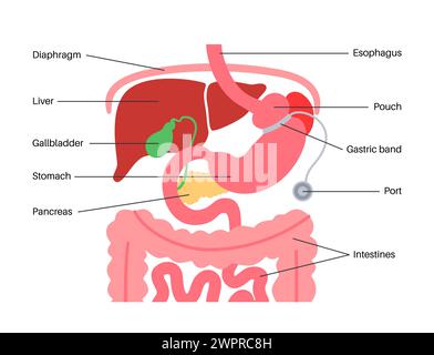 Magenbandärztliches Vorgehen, Illustration Stockfoto