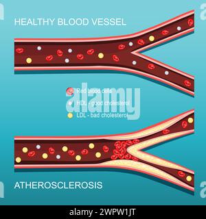 Atherosklerose. Cholesterinspiegel. Querschnitt einer Arterie mit roten Blutkörperchen, HDL, LDL und atheromatösen Plaques. Gutes und schlechtes Cholesterin. Vect Stock Vektor