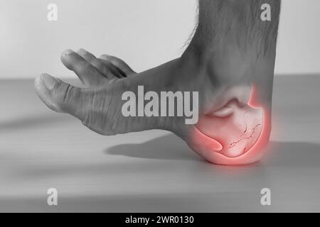 Ein Mann hat eine Fersenverletzung, weil sein Fersenbein gebrochen ist. Stockfoto