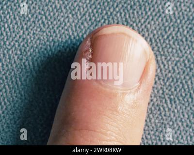 Detailansicht eines Fingers mit verletztem Bereich. Stockfoto