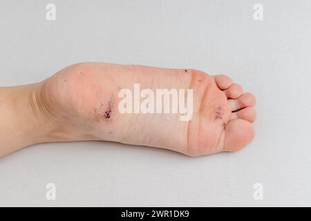 Plantarwarze auf der Ferse des weiblichen Fusses durch hpv oder humanes Papillomvirus. Stockfoto