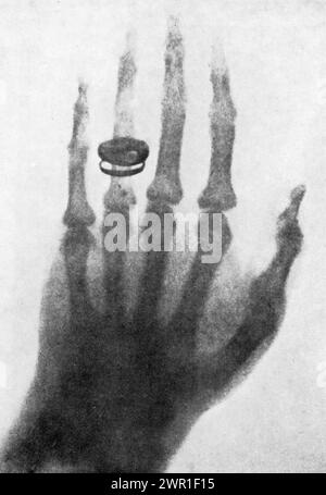 Ein Röntgenbild von Albert von Köllikers Hand, 1896. Von Wilhelm Röntgen (1845-1923). Wilhelm Conrad Röntgen war ein deutscher Maschinenbauingenieur und Physiker, der am 8. November 1895 elektromagnetische Strahlung in einem Wellenlängenbereich erzeugte und detektierte, der als Röntgen- oder Röntgenstrahlen bekannt war, was ihm 1901 den ersten Nobelpreis für Physik einbrachte. Stockfoto