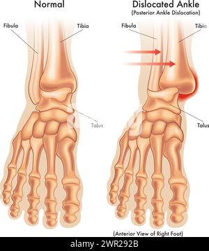Medizinische Illustration zum Vergleich eines normalen Sprunggelenks mit einem expositionierten Knöchel mit Anmerkungen. Stock Vektor