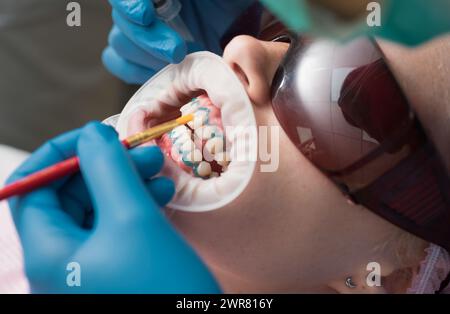 Nahaufnahme des weiblichen Mundes. Technologie-Ultraviolettlampen-Werkzeuge. Perfektes Lächeln nach dem Bleichen. Technologie-Ultraviolettlampen-Werkzeuge. Stockfoto