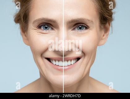 Frauengesicht vor und nach Hautstraffung und Anti-Aging-Verfahren. Entfernen von Falten, Nasolabialfalten, Hautverjüngung Verfahren Stockfoto