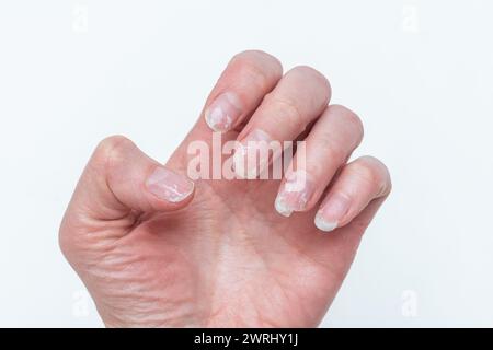 Gebissene und gebrochene Nägel ohne Maniküre mit überwachsener Nagelhaut und beschädigter Nagelplatte nach Auftragen von gellack Stockfoto