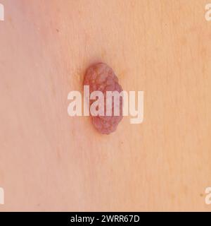 Detaillierte Nahaufnahme eines gutartigen Hauttumors auf klarer Haut Stockfoto