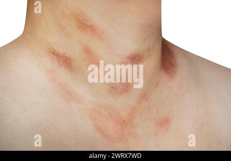 Eine Person mit Pityriasis rosea Krankheit auf Brust und Hals auf einem isolierten Hintergrund Stockfoto