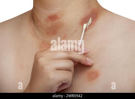 Eine Person mit Pityriasis rosea Krankheit auf Brust und Hals auf einem isolierten Hintergrund. Anwendung von Salbe auf den betroffenen Hautbereich. Stockfoto