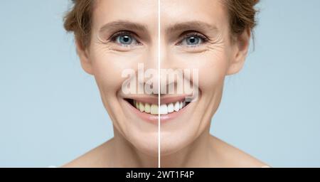 Collage des weiblichen Lächelns vor und nach Zahnaufhellung. Werbeverfahren zur Aufhellung des Lächelns Stockfoto