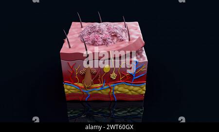 Hautläsion, Abbildung. Stockfoto