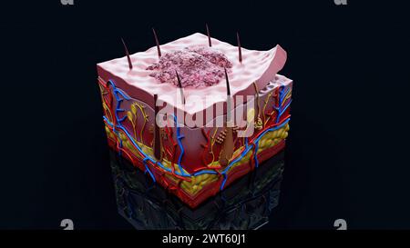 Hautläsion, Abbildung. Stockfoto