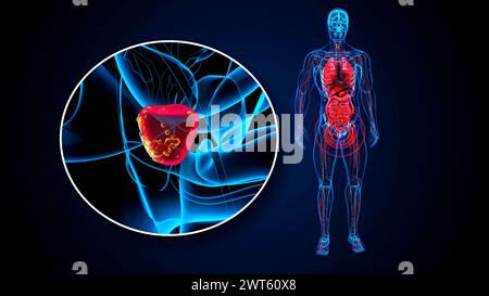 Prostatakarzinom, konzeptuelle Illustration. Stockfoto