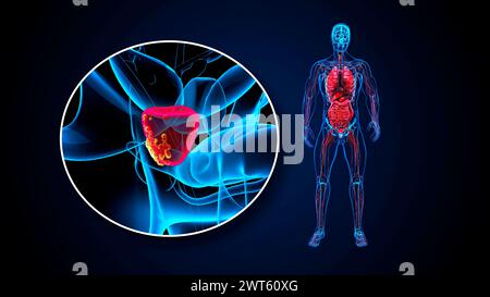 Prostatakarzinom, konzeptuelle Illustration. Stockfoto