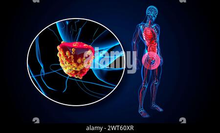 Prostatakarzinom, konzeptuelle Illustration. Stockfoto