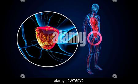 Prostatakarzinom, konzeptuelle Illustration. Stockfoto