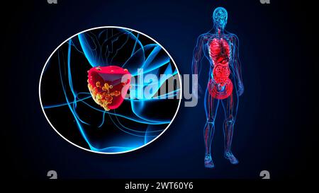 Prostatakarzinom, konzeptuelle Illustration. Stockfoto