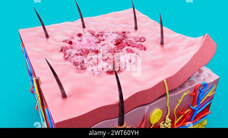 Hautläsion, Abbildung. Stockfoto