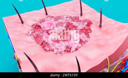 Hautläsion, Abbildung. Stockfoto