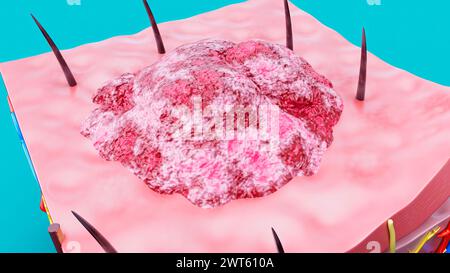 Hautläsion, Abbildung. Stockfoto