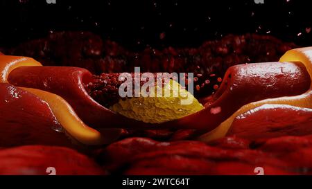 Blutkreislauf und Cholesterinplaque, Thrombus. Gesundheitsschädigungskonzept. Im menschlichen Körper. Stockfoto