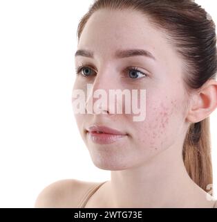 Junge Frau mit Akneproblem auf weißem Hintergrund Stockfoto