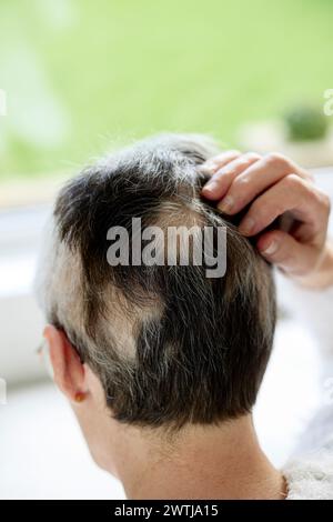 Frau mit Alopezie Stockfoto