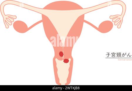 Uteruskarzinom. Querschnitt eines menschlichen Uterus mit