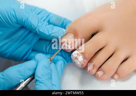 Podologe in blauen Handschuhen, die medizinische Behandlung an weiblichen Zehen im medizinischen Zentrum durchführen. Stockfoto