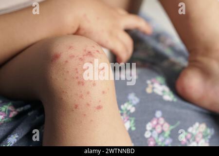 Nahaufnahme des Kniegelenkes des Kindes, das mit einer Hand-Fuß-Mund-Krankheit oder HFMD von Enterovirus oder Coxsackie-Virus infiziert ist, rot auf der Haut Stockfoto