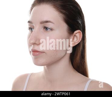 Junge Frau mit Akneproblem auf weißem Hintergrund Stockfoto