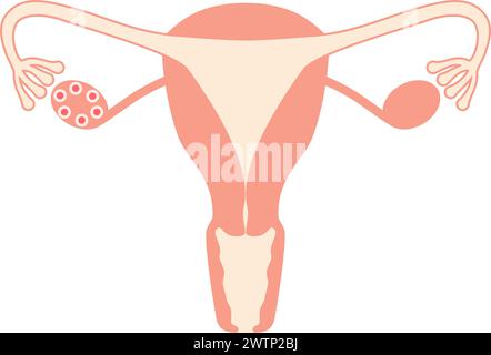 Schematische Darstellung des polyzystischen Ovarialsyndroms (Ovulationsstörung), der Anatomie des Uterus und der Eierstöcke - Übersetzung: Ovulationsversagen Failur Stock Vektor