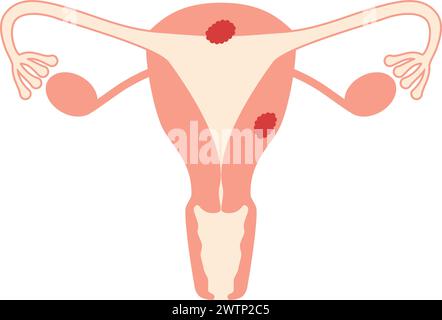 Illustrationen des Endometriumkarzinoms, der Anatomie des Uterus und der Eierstöcke, Vektorillustration Stock Vektor