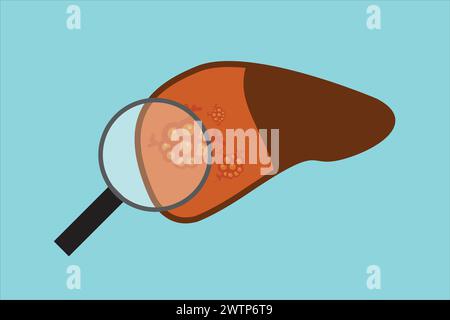 Leberkrebs, Onkologie und Medizin, Lebertumorvektorsymbol, Vektorgrafiken Stock Vektor