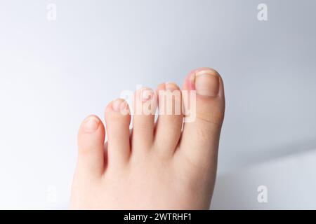 Nahaufnahme eines eingewachsenen Zehennägels, der Beschwerden und mögliche Schmerzen zeigt. Stockfoto