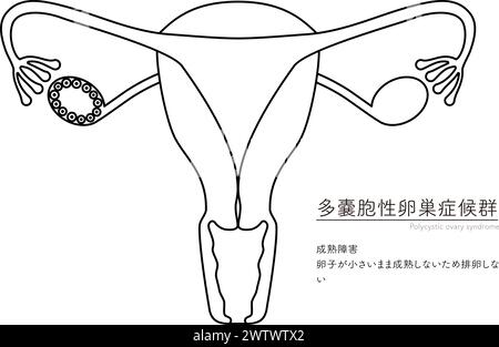 Schematische Darstellung des polyzystischen Ovarialsyndroms (Reifungsstörung), der Anatomie des Uterus und der Eierstöcke - Übersetzung: Reifungsversagen Stock Vektor