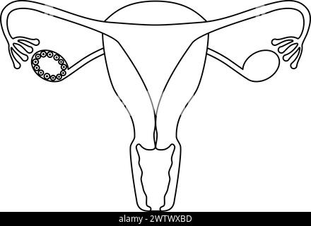 Schematische Darstellung des polyzystischen Ovarialsyndroms (Reifungsstörung), der Anatomie des Uterus und der Eierstöcke - Übersetzung: Reifungsversagen Stock Vektor