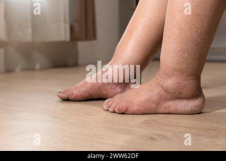 Das Bein der Frau ist ein Ödem (Schwellung) nach Krebsbehandlung. Stockfoto