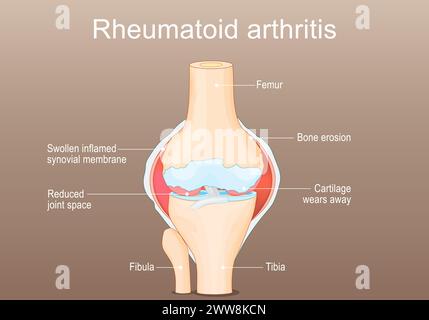 Rheumatoide Arthritis RA. Entzündliche Arthritis, die das Knie betrifft. Autoimmunerkrankung. Das Immunsystem greift irrtümlich gesunde Gelenke an Stock Vektor