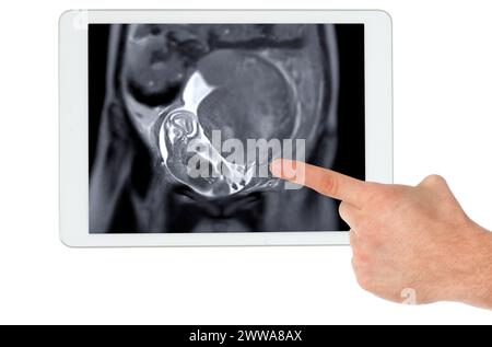 Die MRT während der Schwangerschaft gewährleistet die nichtinvasive Beurteilung der fetalen Gesundheit auf der Tablette, die Sicherheit der Mutter, die geburtshilfliche Versorgung und die diagnostische Präzision Stockfoto