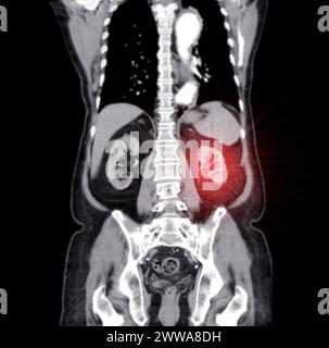 CT-Scan des ganzen Abdomens mit Injektionskontrastmittel in koronaler Sicht. Stockfoto