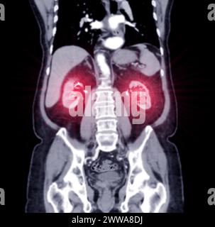 CT-Scan des ganzen Abdomens mit Injektionskontrastmittel in koronaler Sicht. Stockfoto