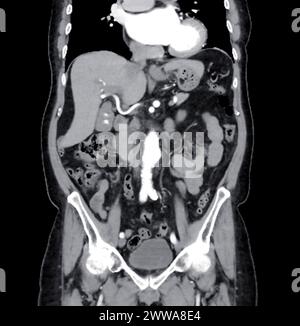 CT-Scan des ganzen Abdomens mit Injektionskontrastmittel in koronaler Sicht. Stockfoto