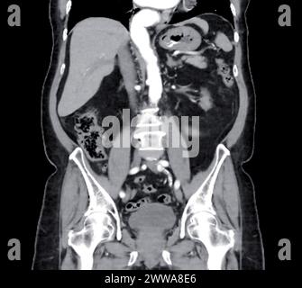 CT-Scan des ganzen Abdomens mit Injektionskontrastmittel in koronaler Sicht. Stockfoto