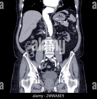 CT-Scan des ganzen Abdomens mit Injektionskontrastmittel in koronaler Sicht. Stockfoto