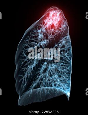 Ein CT-Thorax-3D-Scan, der eine Läsion am rechten Oberlappen zeigt, bietet eine detaillierte Visualisierung, die eine präzise Identifizierung und Behandlungsplanung erleichtert Stockfoto