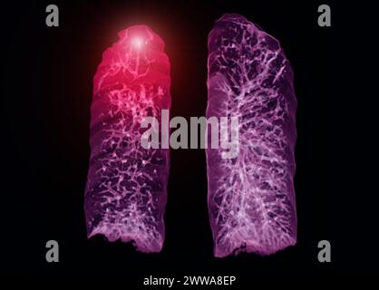Ein CT-Thorax-3D-Scan, der eine Läsion am rechten Oberlappen zeigt, bietet eine detaillierte Visualisierung, die eine präzise Identifizierung und Behandlungsplanung erleichtert Stockfoto