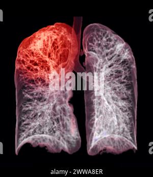 Ein CT-Thorax-3D-Scan, der eine Läsion am rechten Oberlappen zeigt, bietet eine detaillierte Visualisierung, die eine präzise Identifizierung und Behandlungsplanung erleichtert Stockfoto