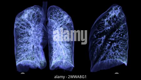 Ein CT-Thorax-3D-Scan, der eine Läsion am rechten Oberlappen zeigt, bietet eine detaillierte Visualisierung, die eine präzise Identifizierung und Behandlungsplanung erleichtert Stockfoto